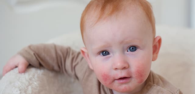 Dermatitis atópica